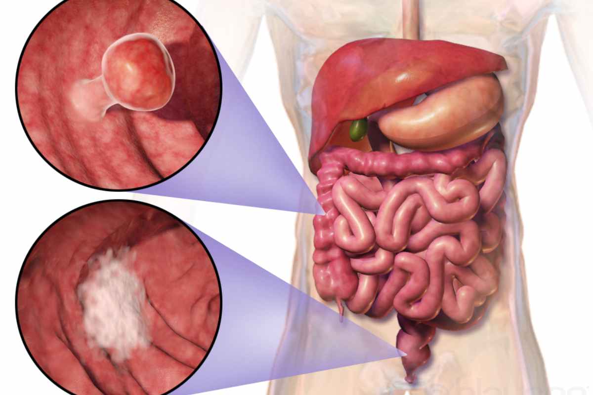 Screening tumore al colon