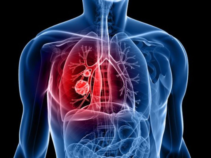 Recidive del tumore al polmone: la scoperta scientifica