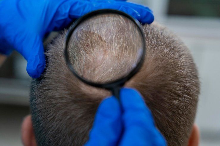 Come ricevere il bonus alopecia