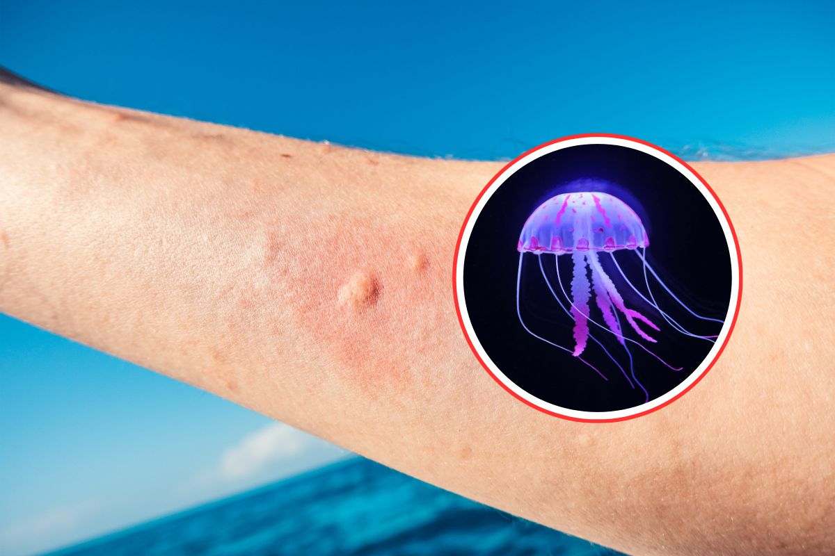 morso di medusa e medusa viola